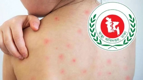 হামের উপসর্গে আরও ৫ শিশুর মৃত্যু